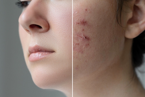 Top 10 Tips for choose Best Product for your Acne