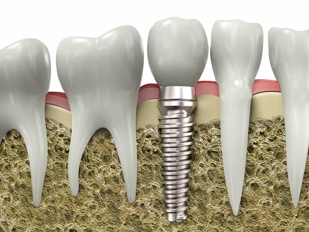 The Stages of Dental Implants: Your Pathway to a Confident Smile